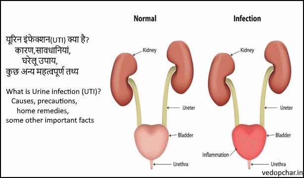 Urine infection(यूरिन इंफेक्शन)(UTI) क्या है? कारण तथा सावधानियां
