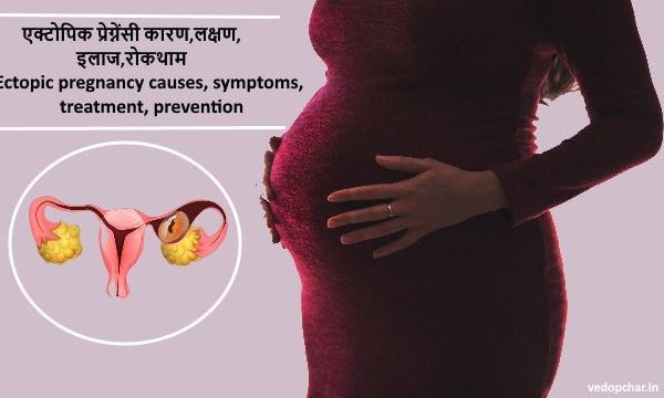 Ectopic pregnancy in hindi:एक्टोपिक प्रेग्नेंसी कारण,लक्षण,इलाज,रोकथाम…