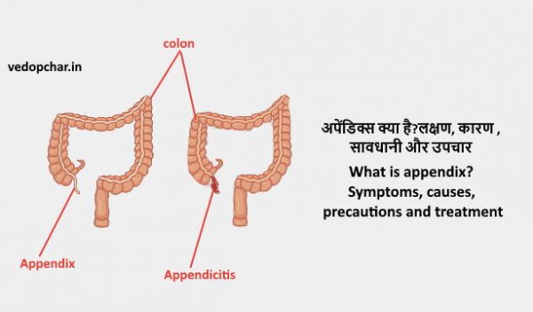 Appendix in hindi:अपेंडिक्स क्या है?लक्षण, कारण ,सावधानी और उपचार