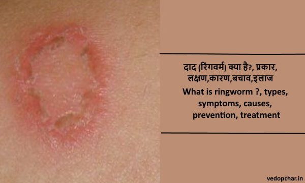 Ringworm in hindi:दाद (रिंगवर्म) क्या है?, प्रकार,लक्षण,कारण,बचाव,इलाज